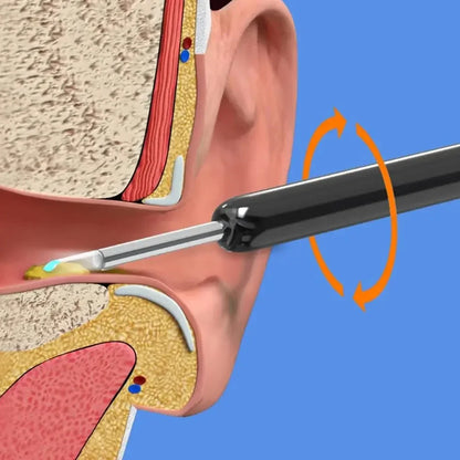 Otoscope Ear Wax Removal